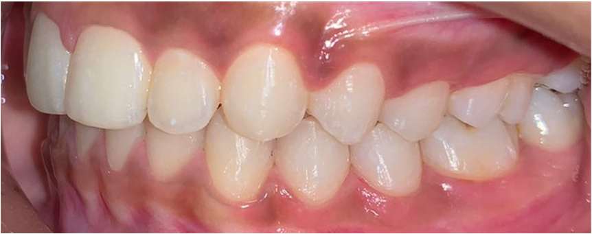 Class 2 Distalization - After